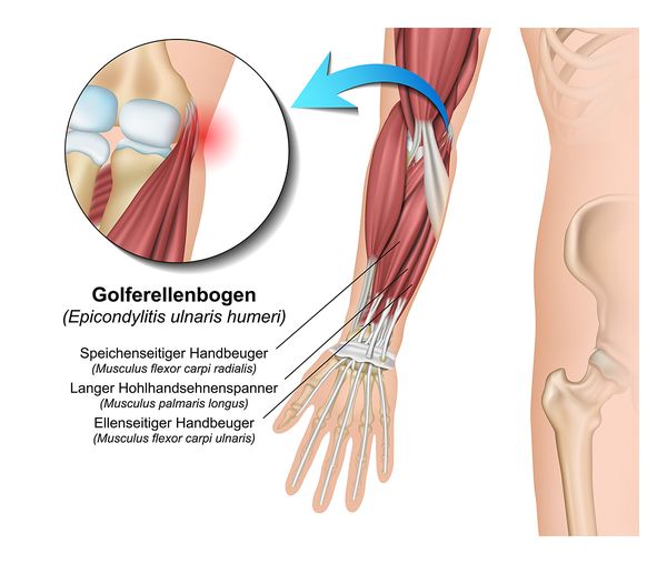 Golferellenbogen