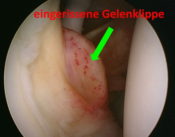 Arthoroskopischer Befund einer Schulterluxation