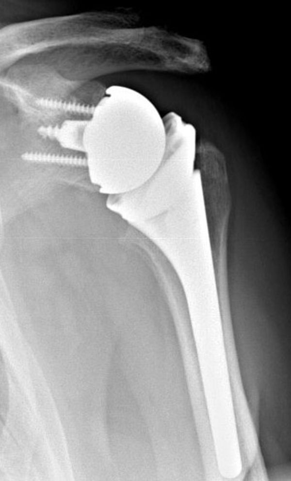 Röntgenbild Totalendoprothese der Schulter