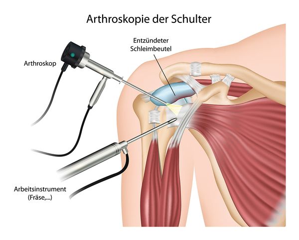 Arthroskopie der Schulter